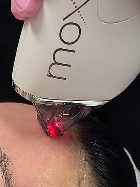 Skincare treatment with laser device on forehead.