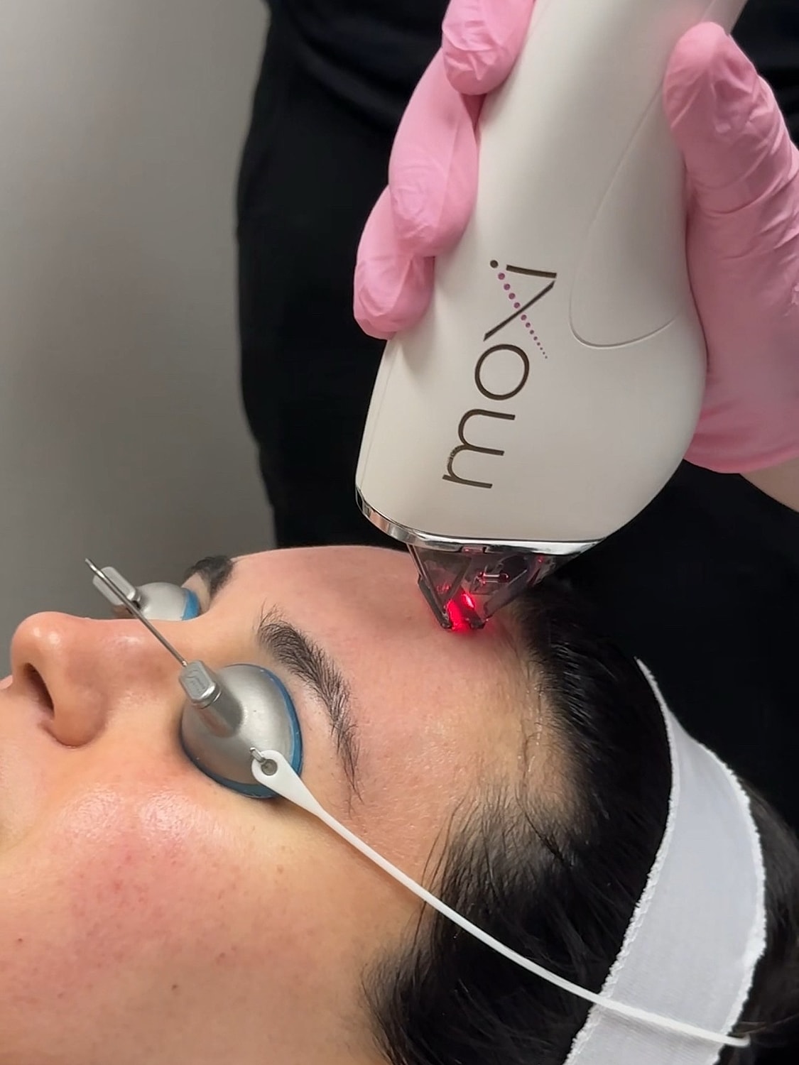Moxi laser treatment on a woman's forehead.