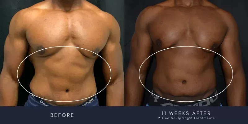 charlotte plastic surgery for men patient before and after