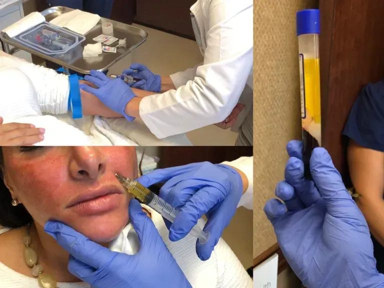 charlotte microneedling with prp patient receiving treatment